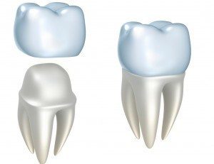 3D graphic of an affordable dental crown
