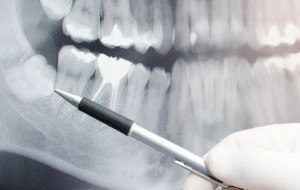 Affordable dental x-ray of tooth extraction