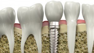 Dental implants can replace as many teeth as necessary