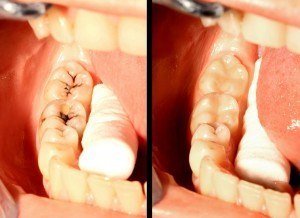 Fillings kept affordable by performing minimally invasive methods that treat cavities sooner, rather than later