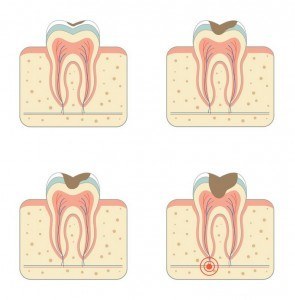 Graphic of the results of our root canal special offer