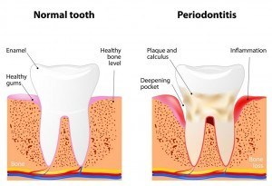 Graphic showing normal tooth and tooth with gum disease