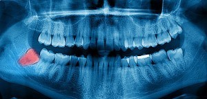 State of the art dental x-ray of a wisdom tooth removal