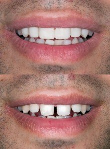 Teeth before and after inexpensive dental bonding treatment