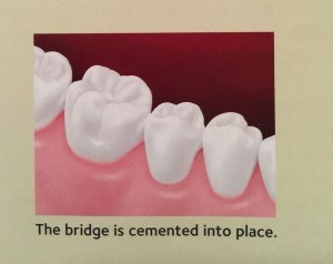 bridge by affordable dentist value smiles