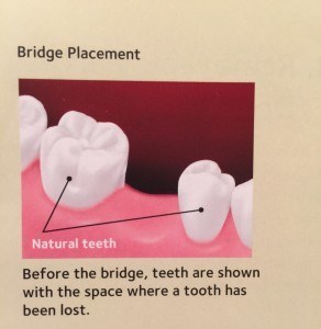 bridge by affordable dentist, value smiles.1