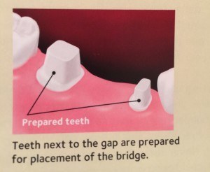 bridge by affordable dentist, value smiles.2