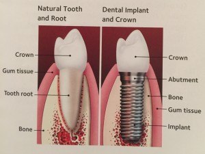 implant.value smies, affordable dental care