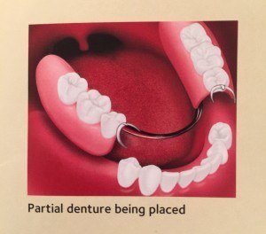 partial denture by affordable dentist, value smiles