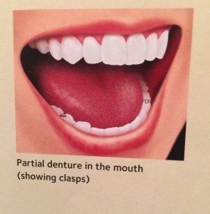 partial denture.1
