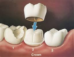 value smiles.affordable dental crown.1