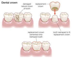 value smiles.affordable dental crown.3